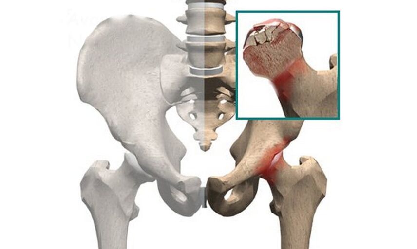 Necrosis of the femoral head is one of the causes of hip joint pain