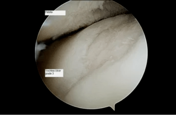 Astroscopic view of a knee joint with 3rd degree arthrosis