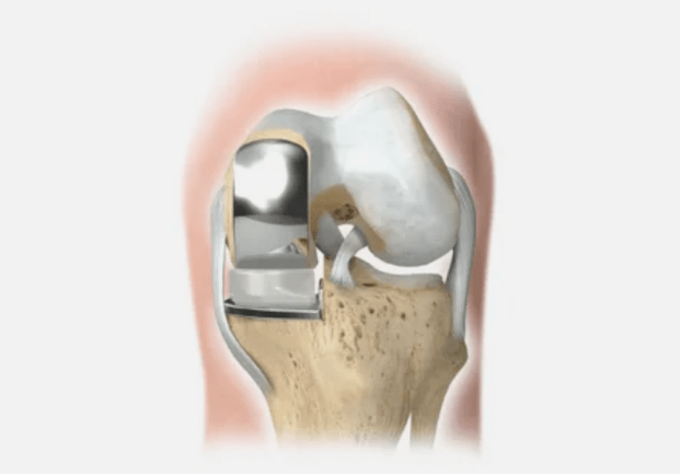 part of the joint is damaged