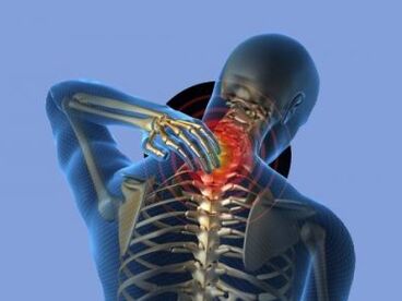 A person with osteochondrosis of the cervical spine is bothered by pain in the neck